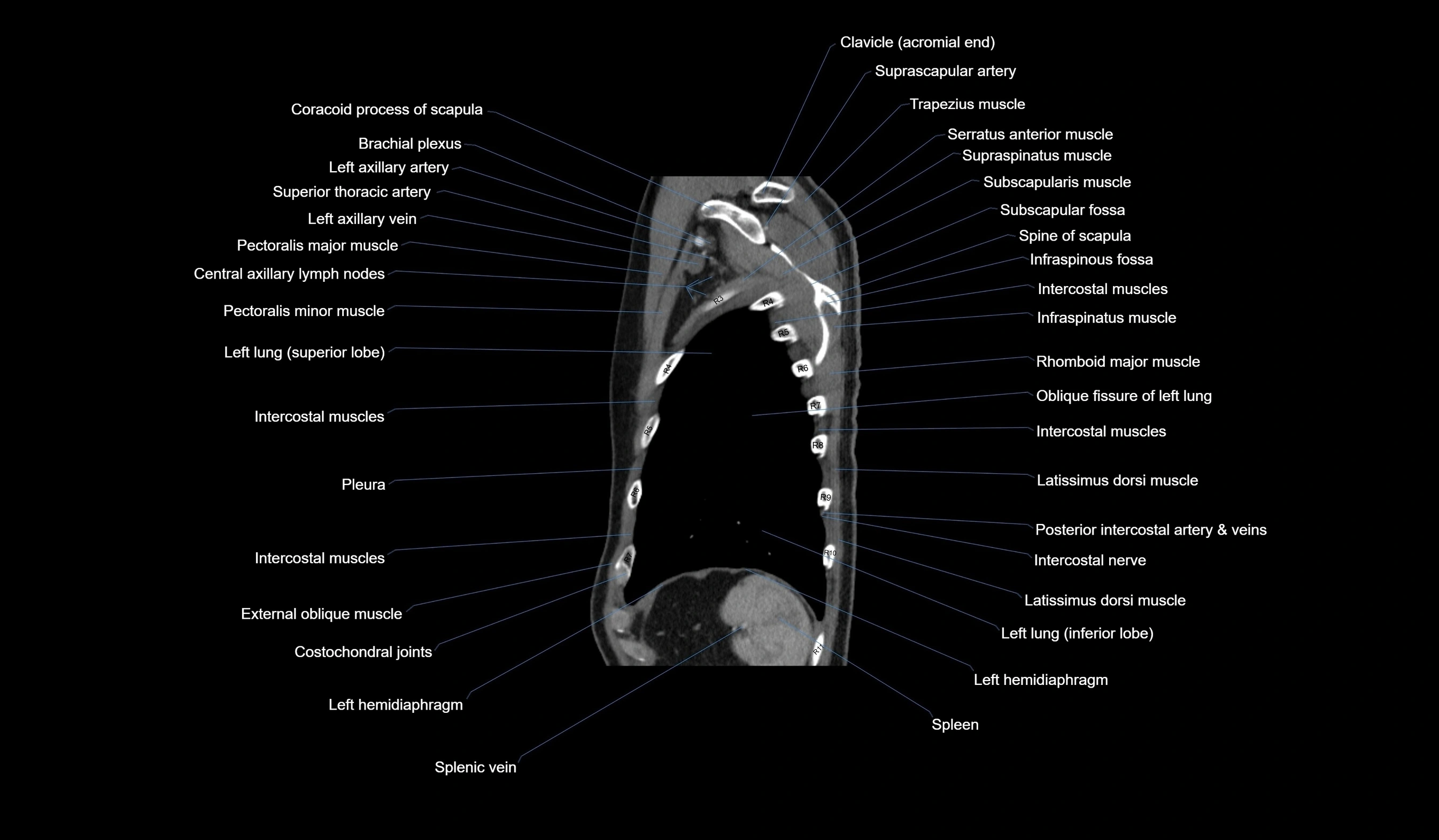CT chest (thorax) soft tissue window labelled sagittal cross sectional anatomy radiology image-00121.webp